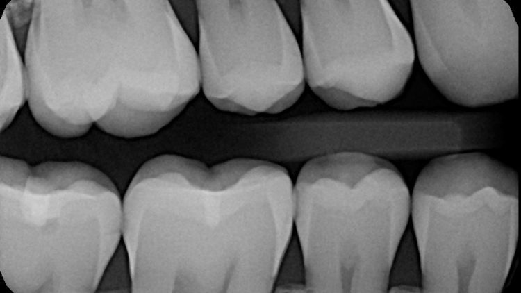 Are dental x-rays really harmful? Why do I need them?