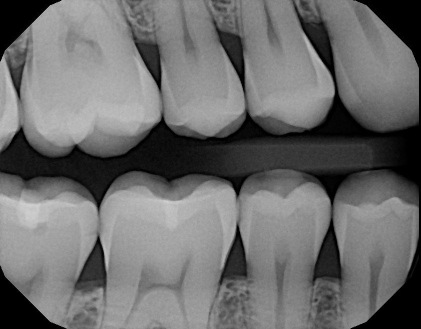 Are dental x-rays really harmful? Why do I need them?