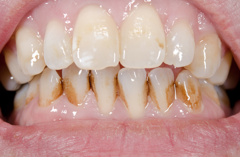 Periodontal diseases: Stained Teeth